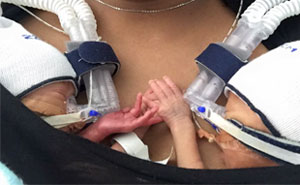 Premature Twins Holding Hands Take Internet By Storm