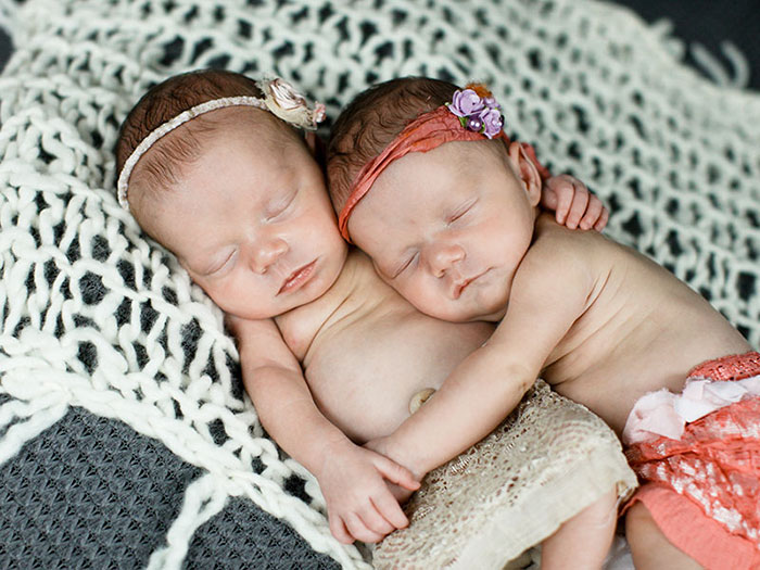 identical-twins-born-holding-hands-jenna-jillian-sarah-thistlethwaite-8