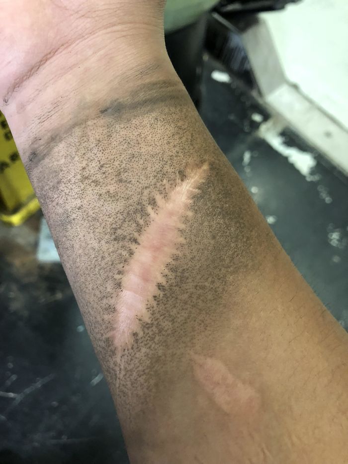 My Scar Doesn’t Get Dirty When I’m At Work