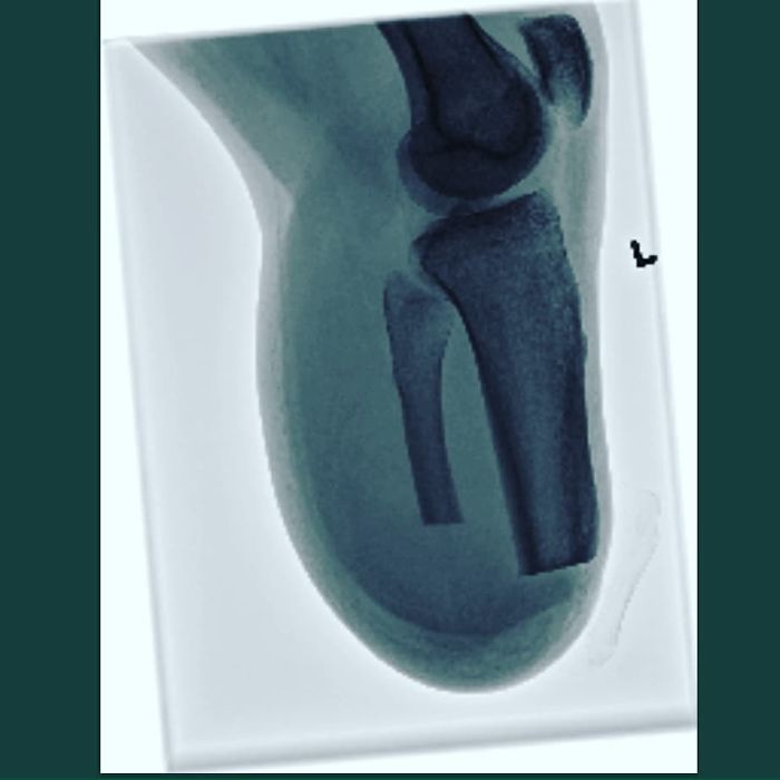 I Finally Got X-Rays Of My Leg After Amputation
