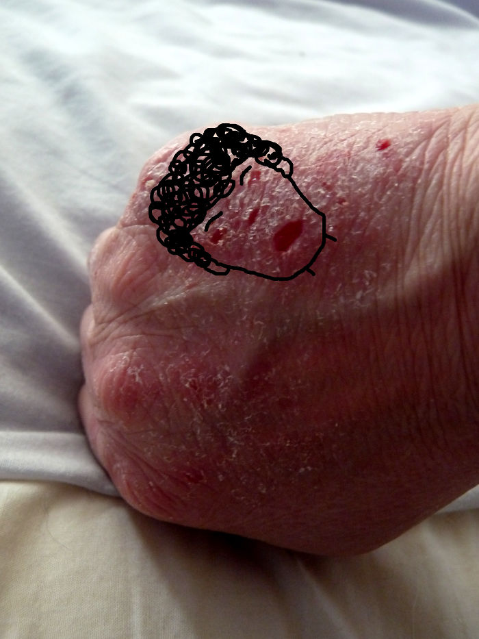 I Found An Angry Benedict Cumberbatch In An Eczema Breakout On My Hand!