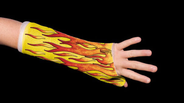Flaming Arm Cast