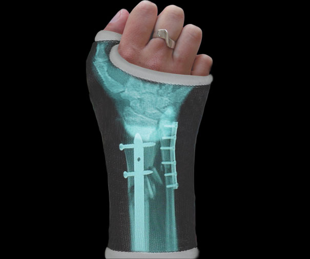 X-ray Cast