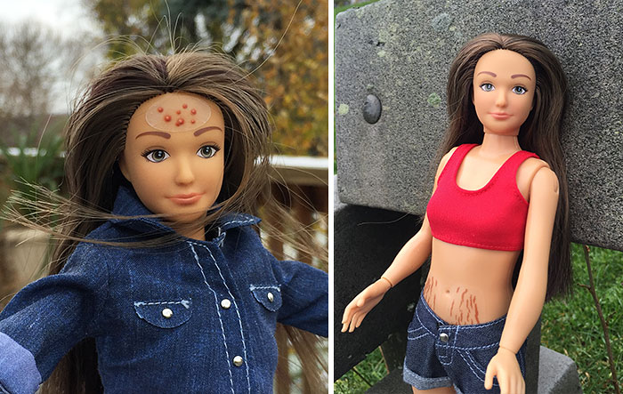 “Normal Barbie” Has Realistic 19-Year-Old Body Shape With Acne, Bruises And Stretch Marks