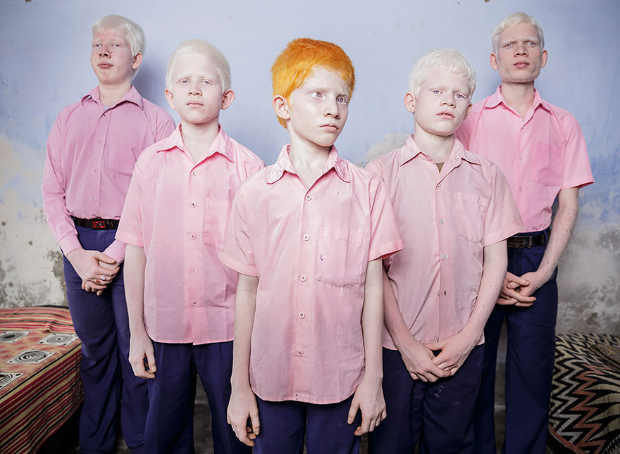 Blind Albino Students Stand In A Dorm At The Vivekananda Mission School In India