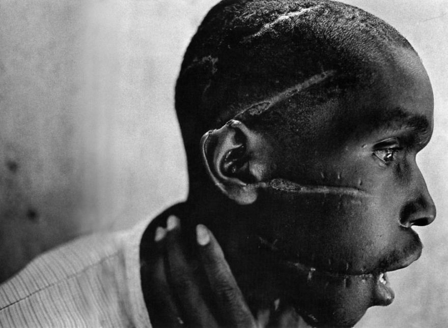 Rwandan Boy Left Scarred After Being Liberated From A Death Camp