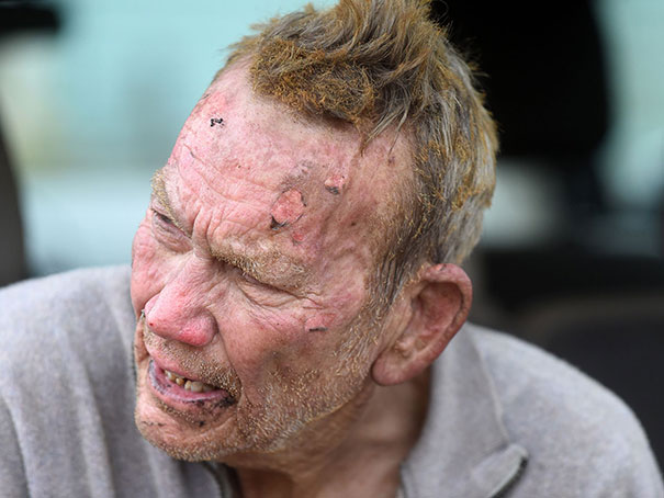 82-Year-Old Man Burned Face While Trying To Save His Dogs From Burning Animal Shelter