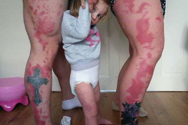 Parents Tattoo Their Legs With Daughter's Birthmark So She Won't Feel Different