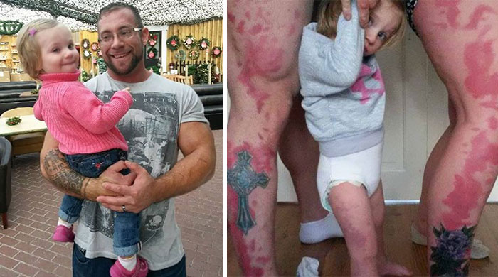 Parents Tattoo Their Legs With Daughter’s Birthmark So She Won’t Feel Different