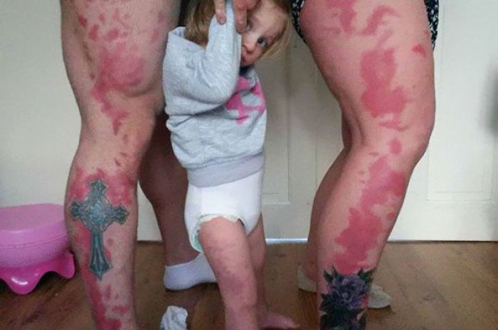 Estos padres se tatuaron la marca de nacimiento de su hija para que no se sintiera distinta