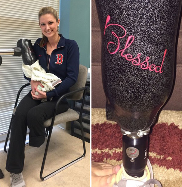 Boston Bombing Survivor Will Run In Marathon Again With Her New Prosthetic Leg