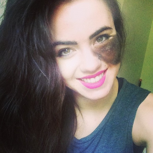 People Told Her To Remove Her Birthmark, But She Chose To Embrace It Instead