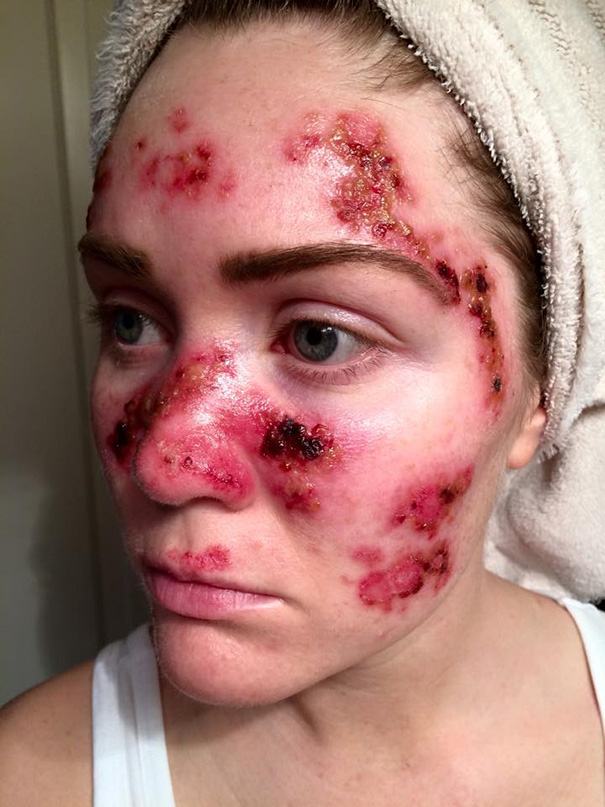 Woman With Skin Cancer Posts Graphic Selfie To Show The Dangers Of Tanning