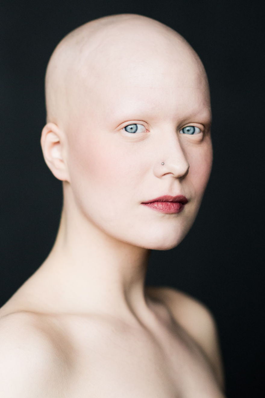 Baldvin: I Photograph Women With Alopecia To Break Gender Stereotypes
