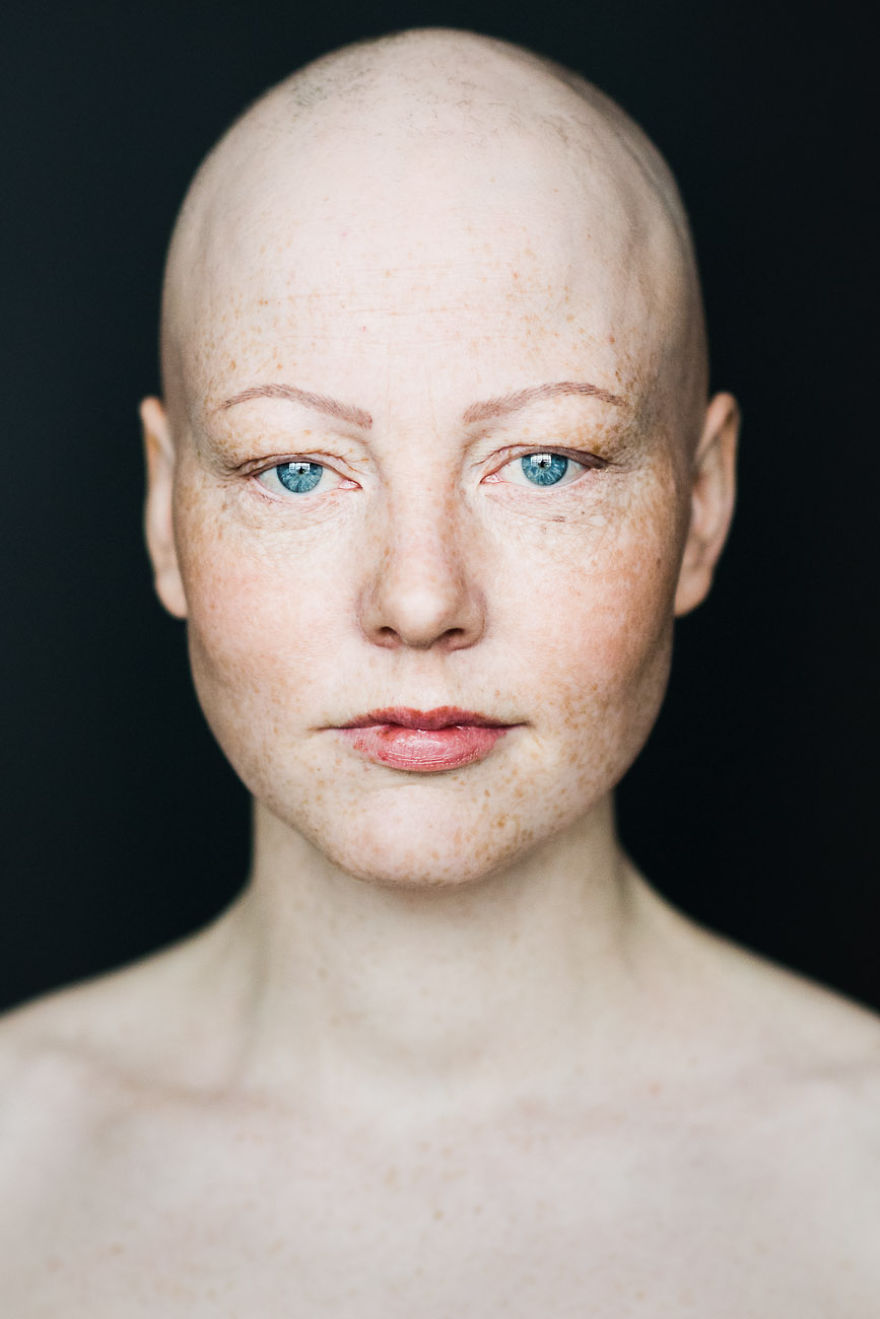 Baldvin: I Photograph Women With Alopecia To Break Gender Stereotypes