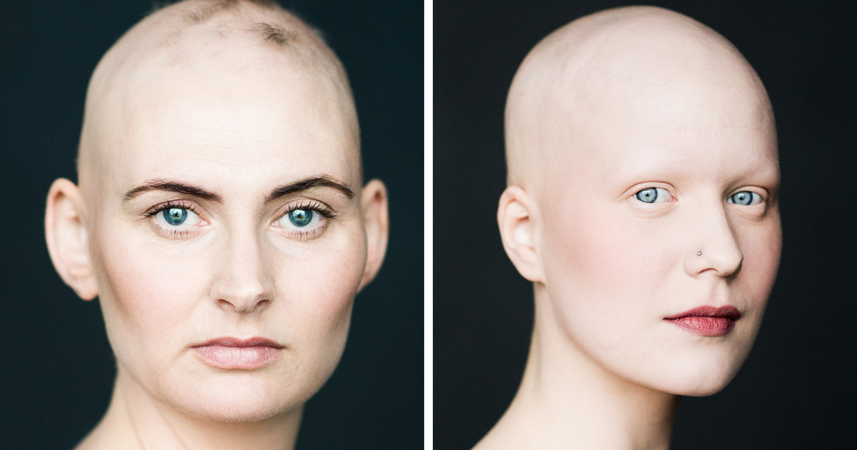 Baldvin: I Photograph Women With Alopecia To Break Gender Stereotypes |  Bored Panda