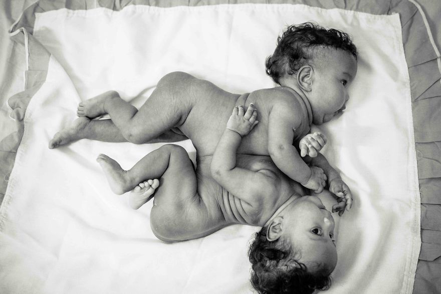These 2-Months-Old Conjoined Twins Share One Liver And I Had The Honor To Photograph Them
