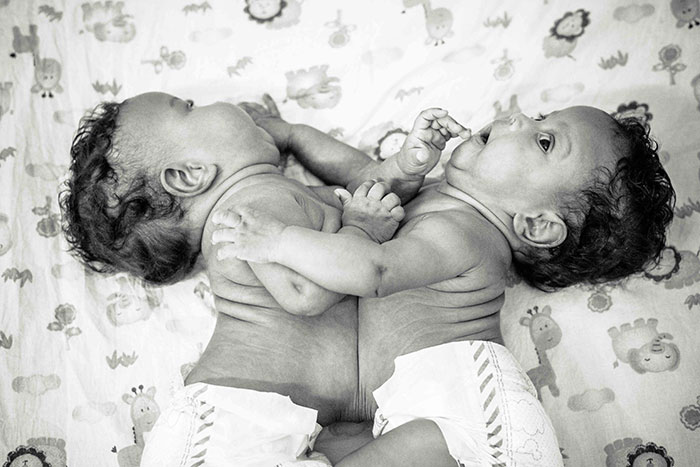These 2-Months-Old Conjoined Twins Share One Liver And I Had The Honor To Photograph Them