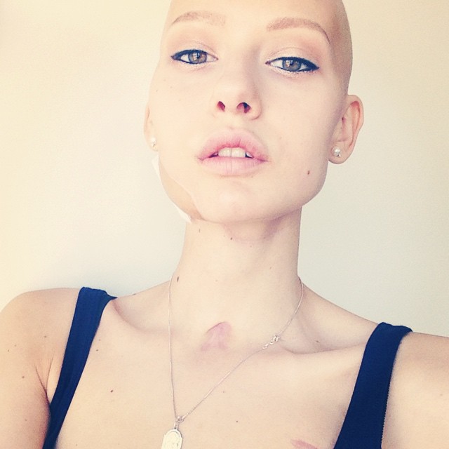 Doctors Told Model To Abort Her Child After She Lost 95% Of Her Jaw To Cancer. This Is What She Did