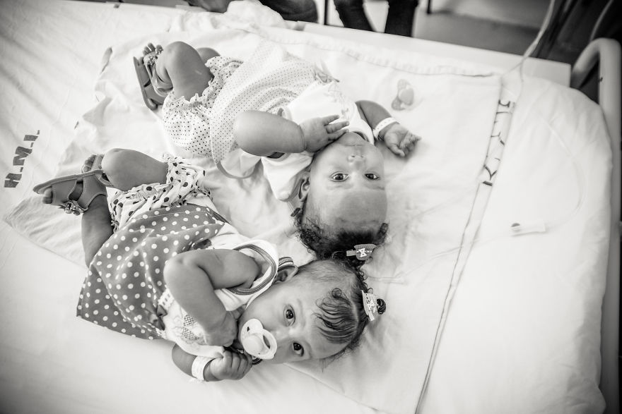 Conjoined Twins After Separation Surgery