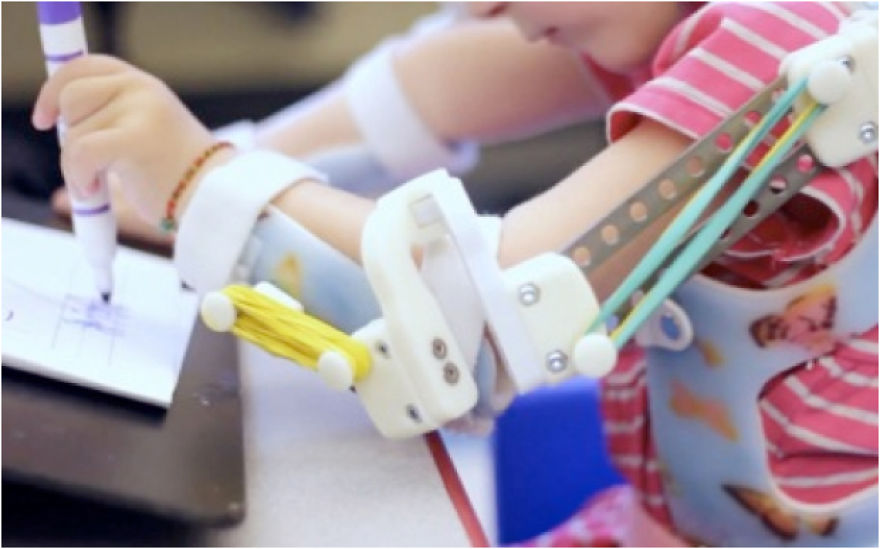 Magic Arms: 3D-Printed Device Helps People With Rare Conditions Move Their Arms
