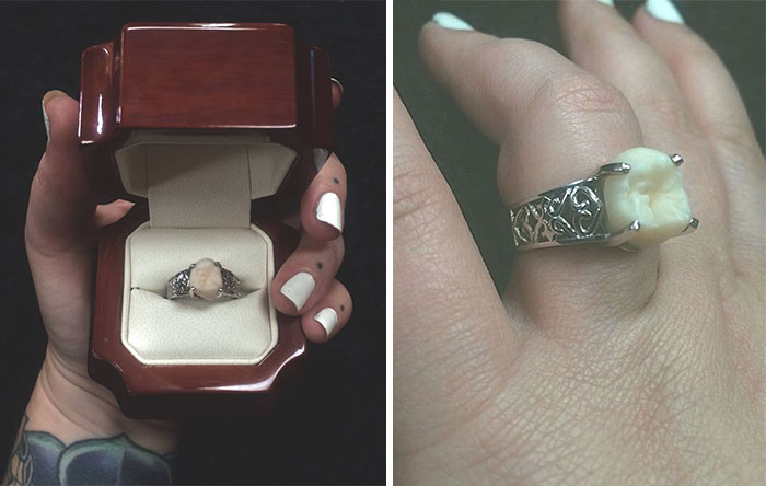 This Woman Got An Engagement Ring With Her Fiance’s Wisdom Tooth