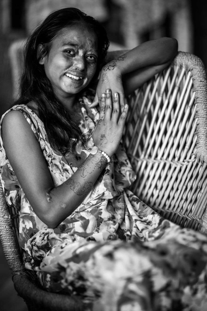 I Took Portraits Of Acid Attacks Survivors In India