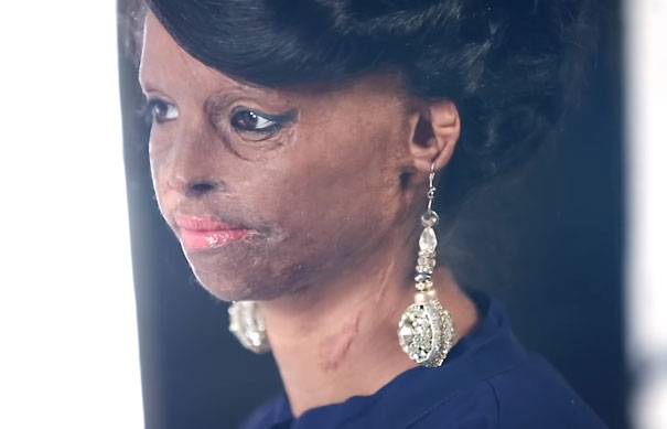 Acid Attack Survivor Becomes Face Of Fashion Brand In India
