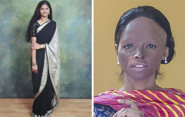Acid Attack Survivor Becomes Face Of Fashion Brand In India