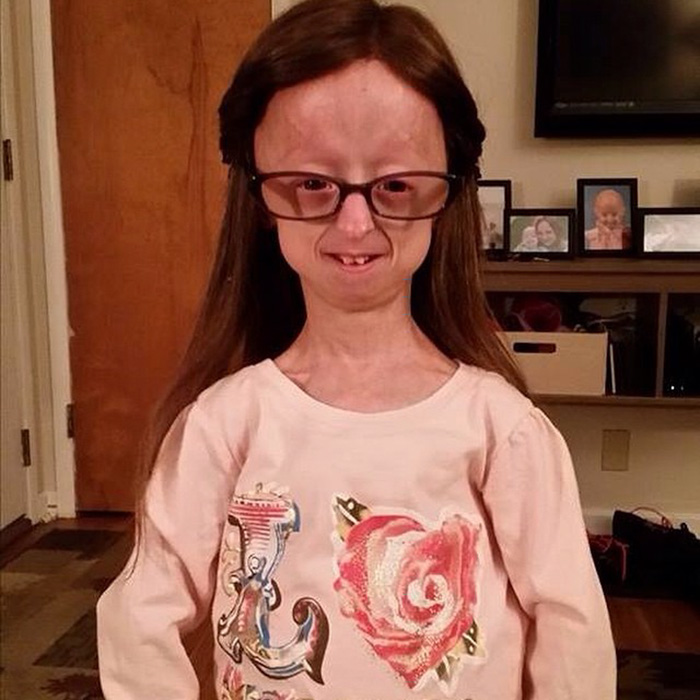 girl-rare-disease-progeria-powerlifter-friendship-lindsay-ratcliffe-david-douglas-10
