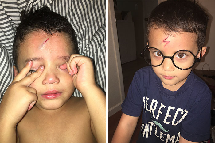 Mom Turns Crying Kid’s Cut Into Harry Potter Lighting Bolt, Makes Him Happy Again