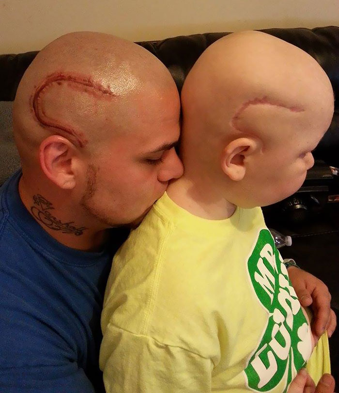 Dad Tattoos His Son's Cancer Scar On His Own Head To Boost Son's Self-Confidence