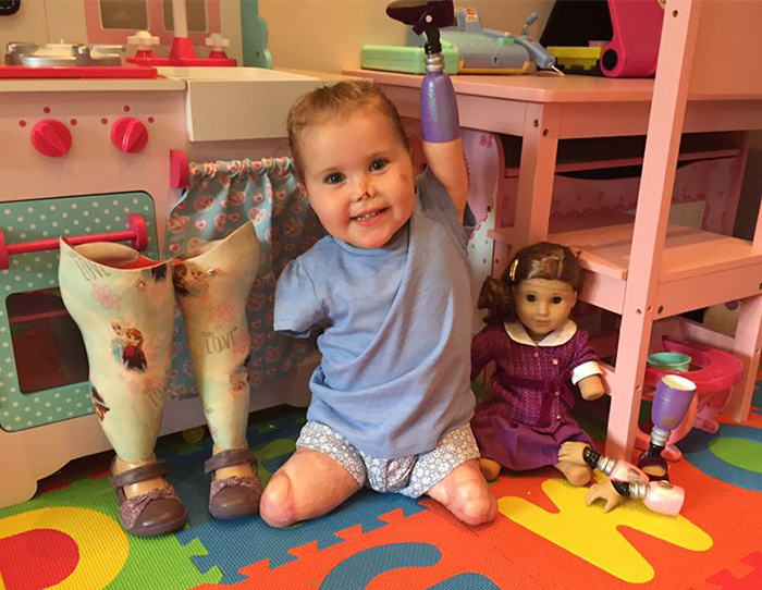 2-Year-Old Girl Gets Quadruple Amputee Doll That Looks Just Like Her