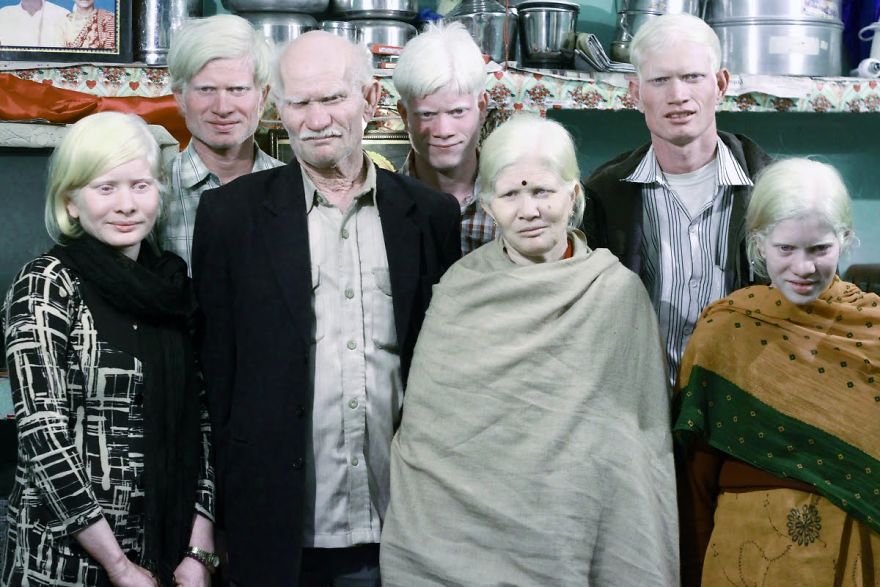 The World’s Biggest Albino Family