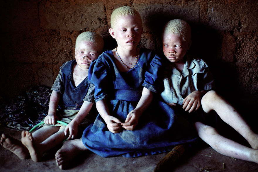 Albino Children In Tanzania
