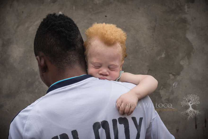 Albino Baby