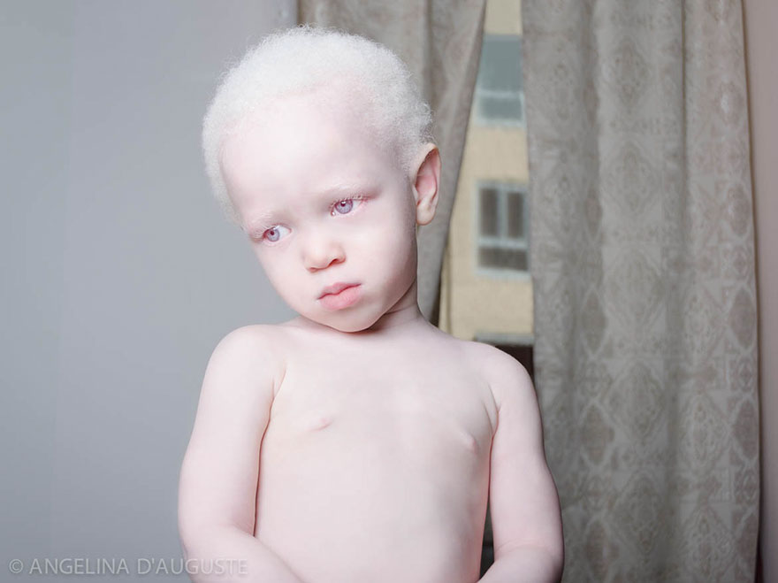Albino Boy