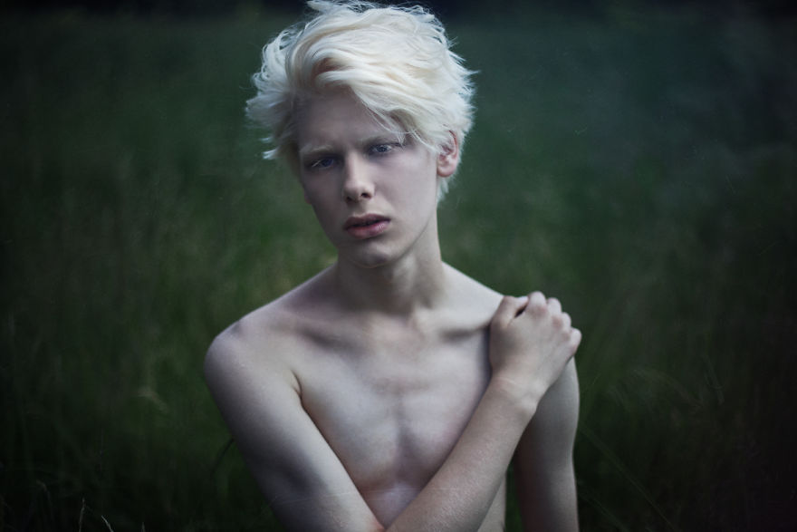 Albino Man