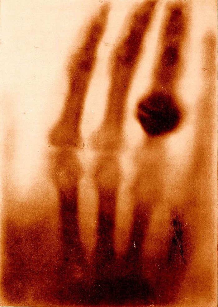 X-ray image of a hand with a ring, representing one of the most famous photos in history.