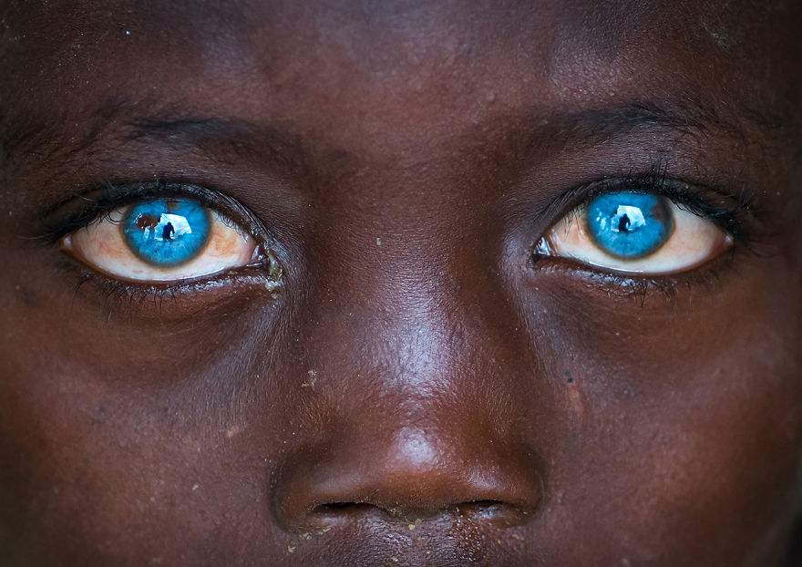 I Met Ethiopian Boy With The Plastic Eyes