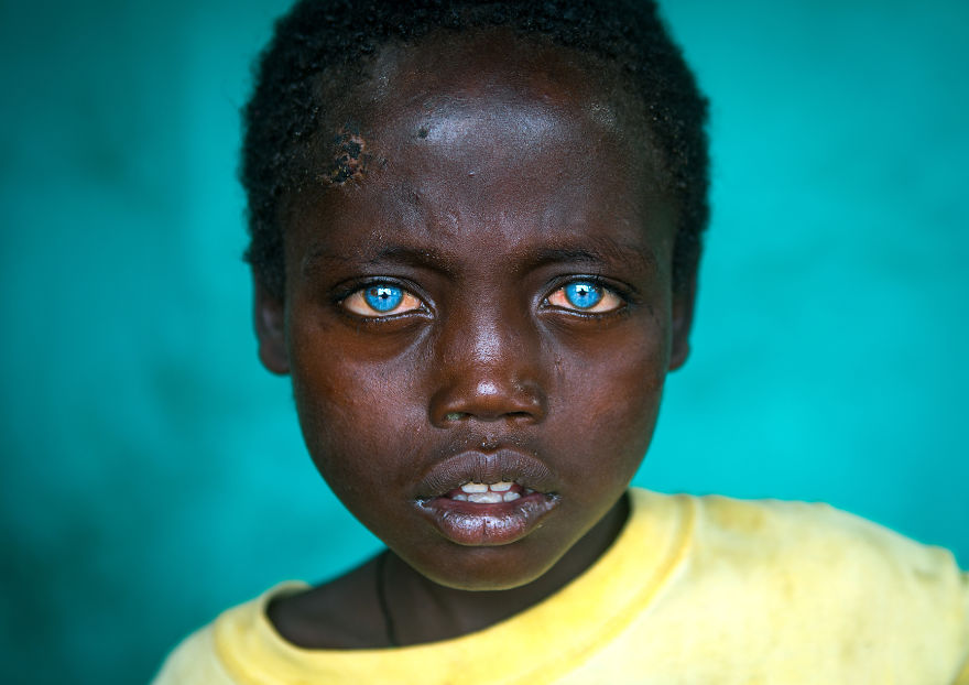 I Met Ethiopian Boy With The Plastic Eyes