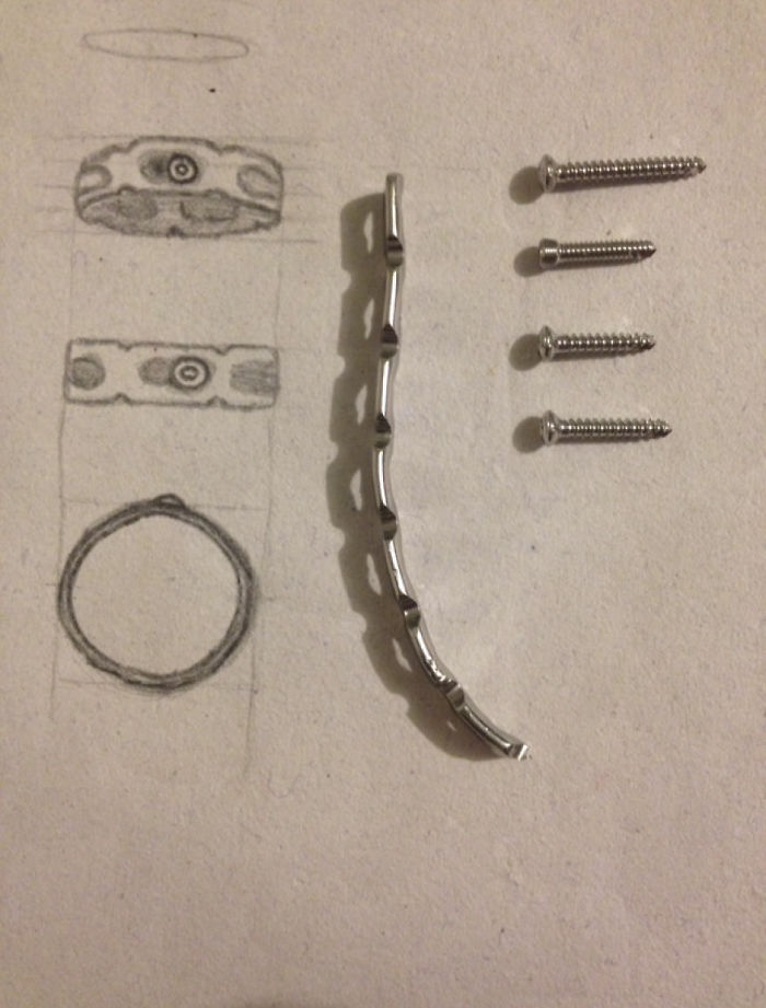 I Made A Ring Out Of The Metal Plate From My Surgery