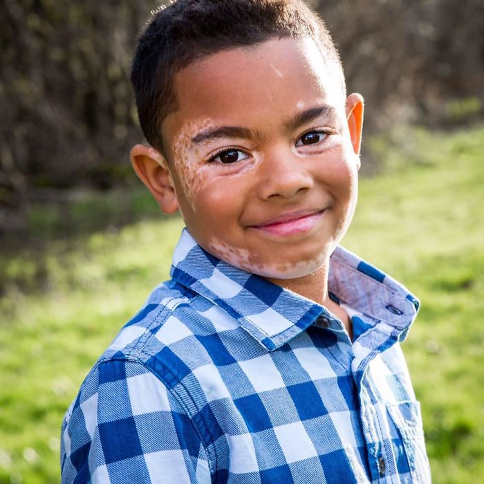 Boy With A Rare Skin Disorder Hates His Looks, Until He Meets His Dog Twin