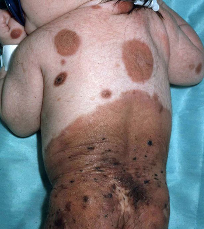 bullied-student-congenital-melanocytic-nevus-model-alba-parejo-3