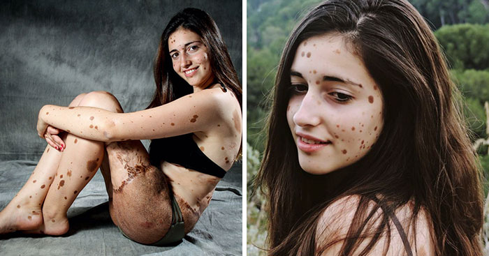 This Teen Was Brutally Bullied For Having Over 500 Birthmarks, But Look At Her Now