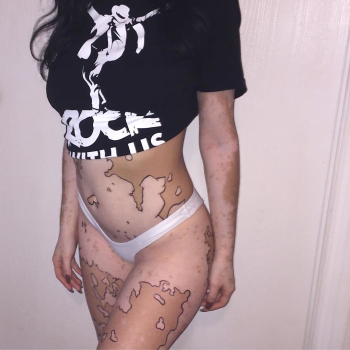 After Being Bullied For Vitiligo All Her Life, This Girl Now Turns Her Body Into Amazing Art