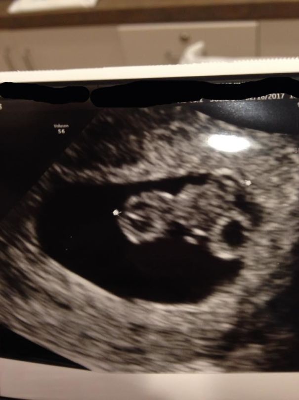 Friend's Ultrasound Looks Like A Dude Riding A Motorcycle