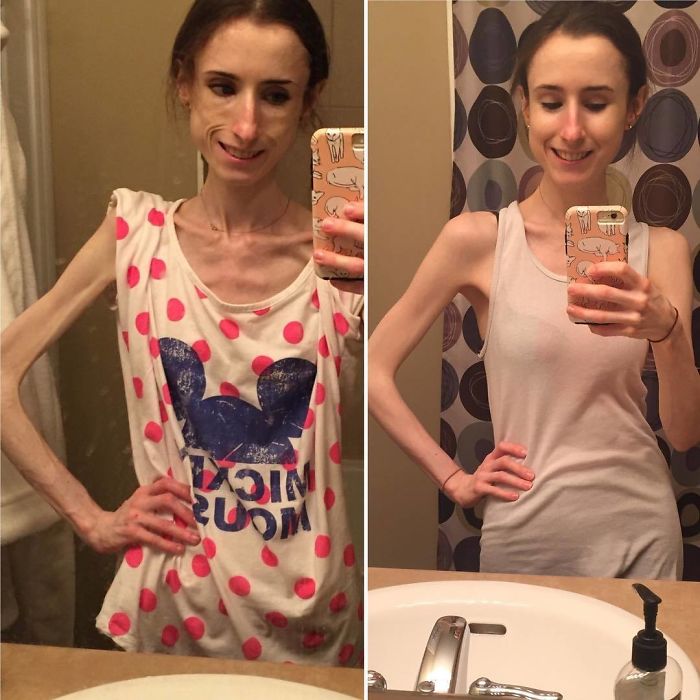 Anorexia Before And After Photos Of Anorexia