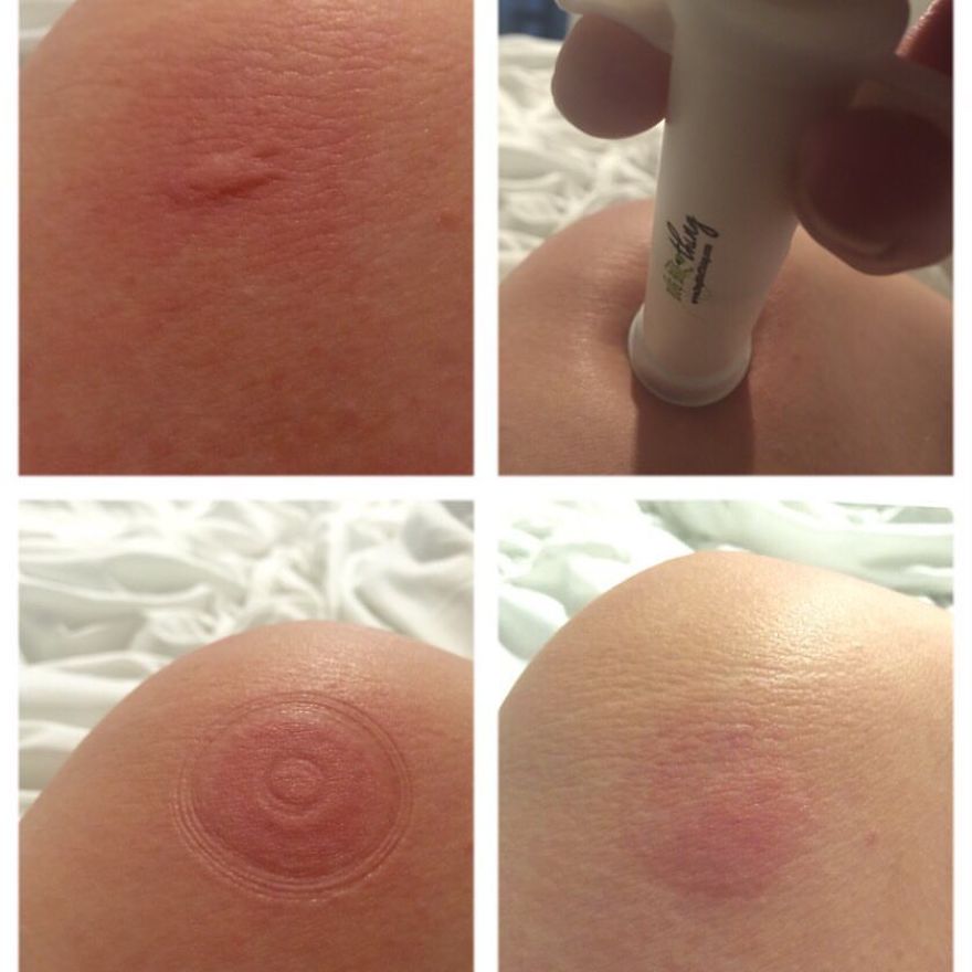 Award Winning Bug Bite Thing Suction Tool Stops The Pain And Itch From Insect Bites Fast And Effectively