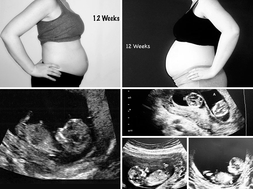 Side By Side Comparison Of My Singleton Pregnancy And My Twin Pregnancy